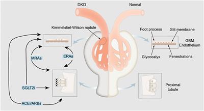 A new perspective on proteinuria and drug therapy for diabetic kidney disease